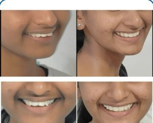 Facial Profile & Overjet Correction