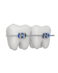 Crowded Teeth